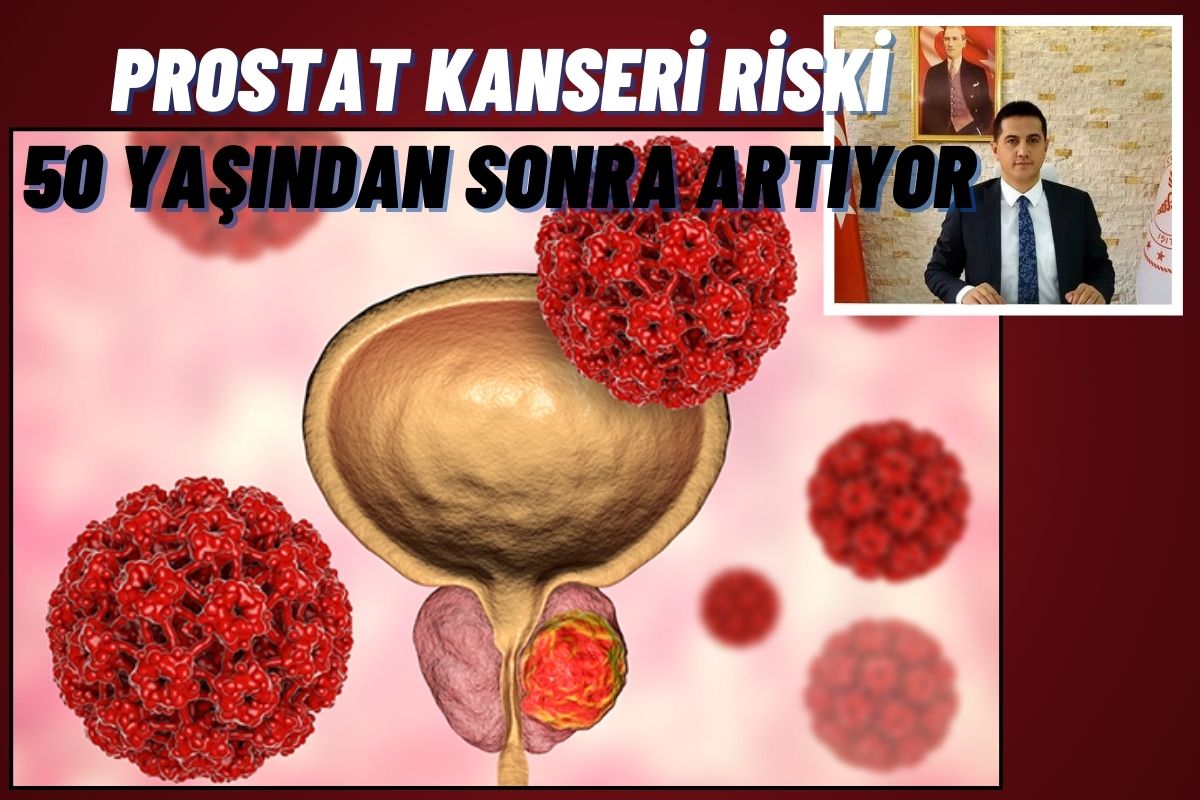 Prostat Kanseri Riski 50 yaşından sonra artıyor